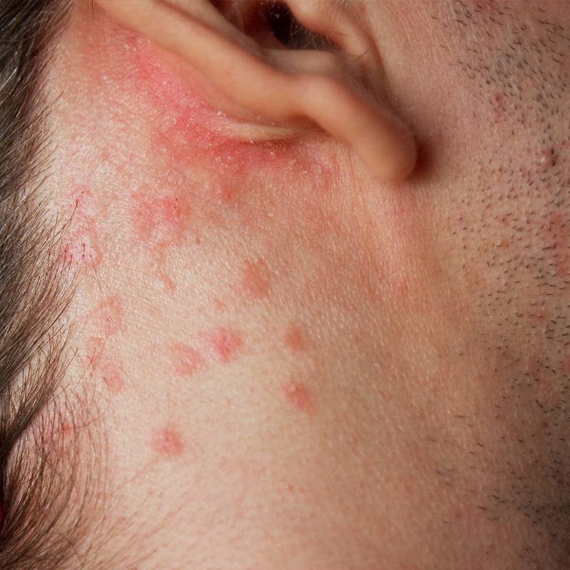 psoríase ao redor da orelha