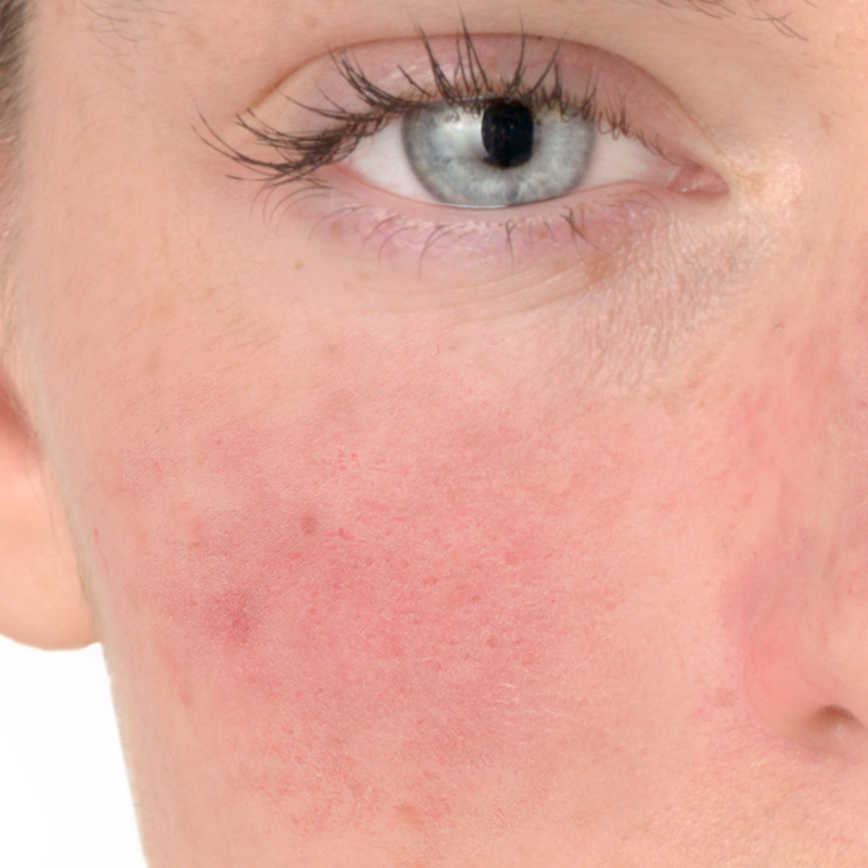 Sintomas de rosácea, vermelhidão nas bochechas e nariz
