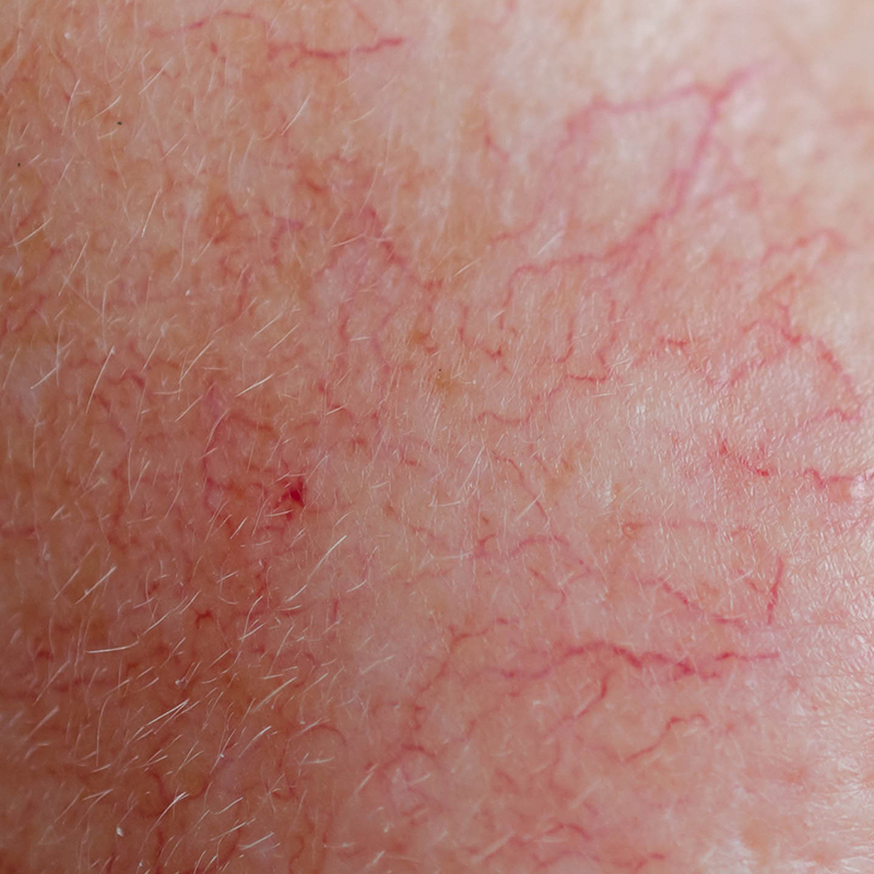 Close-up da pele facial mostrando vermelhidão persistente
