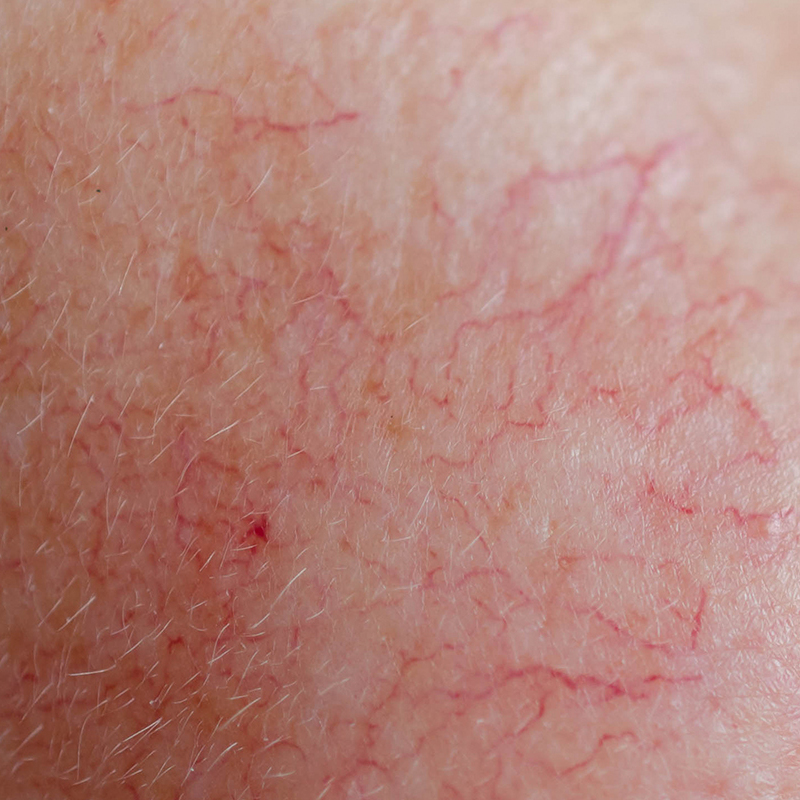 Close-up da pele facial mostrando vermelhidão persistente