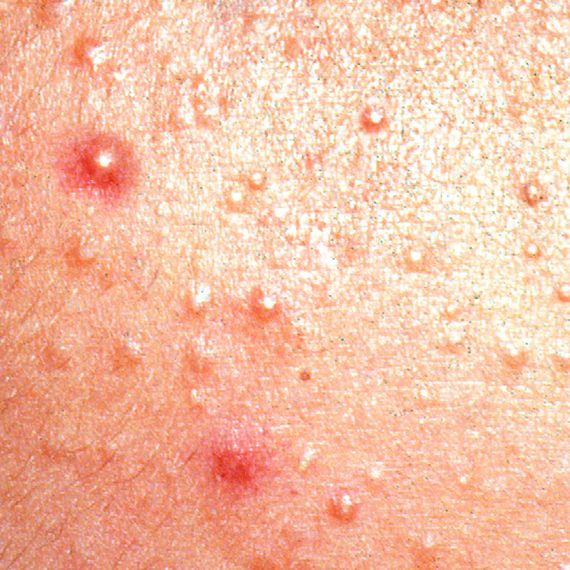 Acne rosácea com inchaços visíveis e vermelhidão no sen