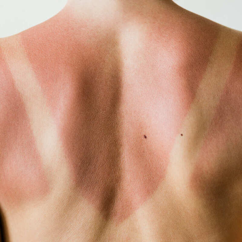 pele e bronzeado nas costas