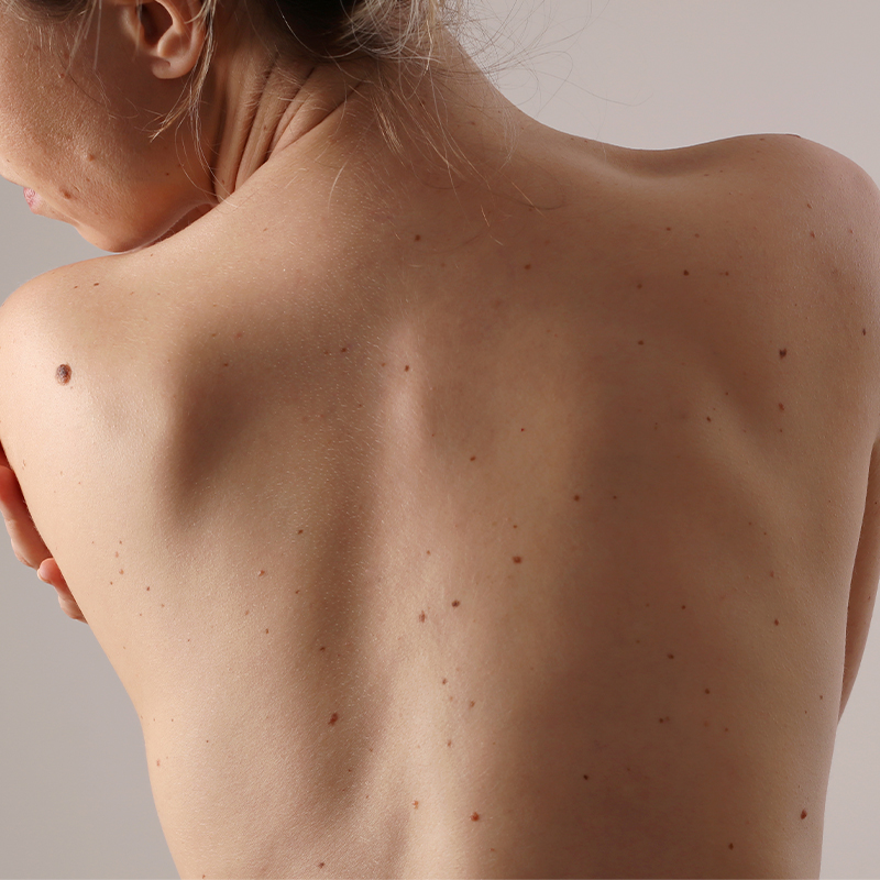 Costas de mulher sem cicatrizes